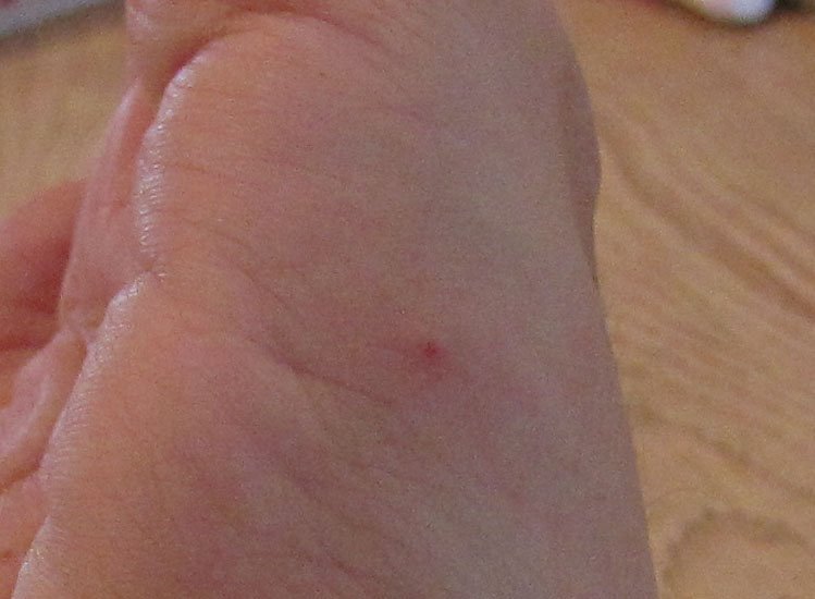 Chagas Disease Chagas Disease